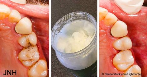 Coconut Oil Mouth Rinse, Benefits Of Coconut Oil For Teeth, Oil Pulling For Cavities, Clove And Coconut Oil Teething, Coconut Oil Pulling Teeth Heal Cavities, Coconut Oil Pulling Teeth, White Teeth Coconut Oil, Mouth Rinse, Coconut Oil For Teeth