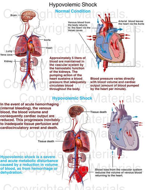 Hypovolemic Shock Shock Nursing, Hypovolemic Shock, Nclex Practice Questions, Emt Study, Types Of Shock, Traffic Accident, Cardiac Nursing, Med Surg, Nursing School Notes