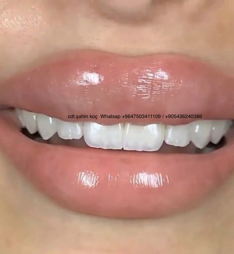 Teeth Makeover, Natural Teeth Whitening Remedies, Teeth Aesthetic, Pretty Teeth, Hollywood Smile, Flamboyant Gamine, Teeth Whitening Remedies, Beautiful Teeth, Perfect Teeth