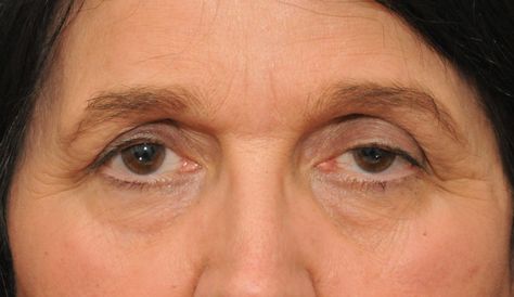 How To Treat Droopy Eyes Naturally and Effectively Natural Remedies For Warts, Natural Wart Remedies, Warts On Face, Warts Remedy, Droopy Eyelids, Droopy Eyes, Get Rid Of Warts, Healthy Eyes, Eyes Problems