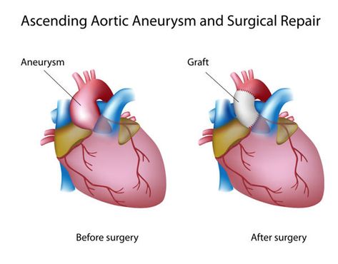 Bicuspid Aortic Valve, Heart Surgery Recovery, Aortic Valve Replacement, Medical Things, Abdominal Aorta, Heart Pain, Heart Warrior, Heart Surgeon, Heart Valves