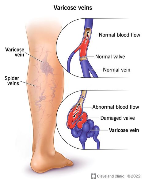 What Are Varicose Veins? Pelvic Congestion Syndrome, Purple Veins, Venous Insufficiency, Laser Therapy, Blood Vessels, Fitness Motivation, Spray, Skin, Health