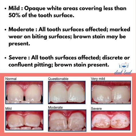 Classification Dental Fluorosis, Stain, Quick Saves