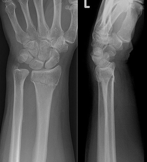 Lucian And Sloane, Colles Fracture, Xray Images, Wrist Anatomy, Radiography Student, Open Fracture, Types Of Fractures, Medical Radiography, Ulnar Nerve