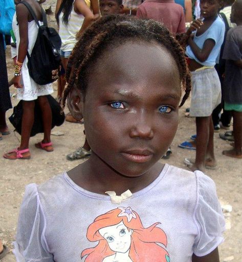 Waardenburg Syndrome - a person with this syndrome will also normally have a nose that looks like a ski slope, with no dip or bump.  Often the upper lip is missing the cupid's bow. Black With Blue Eyes, People With Blue Eyes, Girl With Blue Eyes, Beautiful Blue Eyes, We Are The World, Natural Phenomena, People Of The World, African Beauty, Pretty Eyes