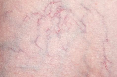 How Varicose and Spider Veins Are Different – Cleveland Clinic Vericous Veins, Facial Veins, Varicose Veins Causes, Leg Ulcers, Visible Veins, Black Veins, Venous Insufficiency, Medical School Motivation, Cleveland Clinic