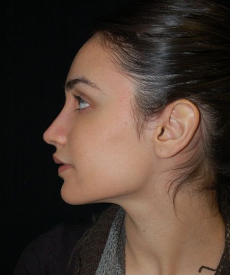 Case 86 Rhinoplasty Before and After Photos - Board Certified Plastic Surgeon Beverly Hills CA Closed Rhinoplasty, Face Plastic Surgery, Nose Fillers, Rhinoplasty Before And After, Job Inspiration, Straight Nose, Perfect Nose, Celebrity Plastic Surgery, Queen Hair