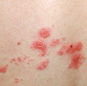 Using L-Lysine Against Shingles | The People's Pharmacy Shingles Remedies, Shingles Rash, Homeopathy, Natural Treatments, Natural Food, Home Remedies, Natural Remedies, Cider