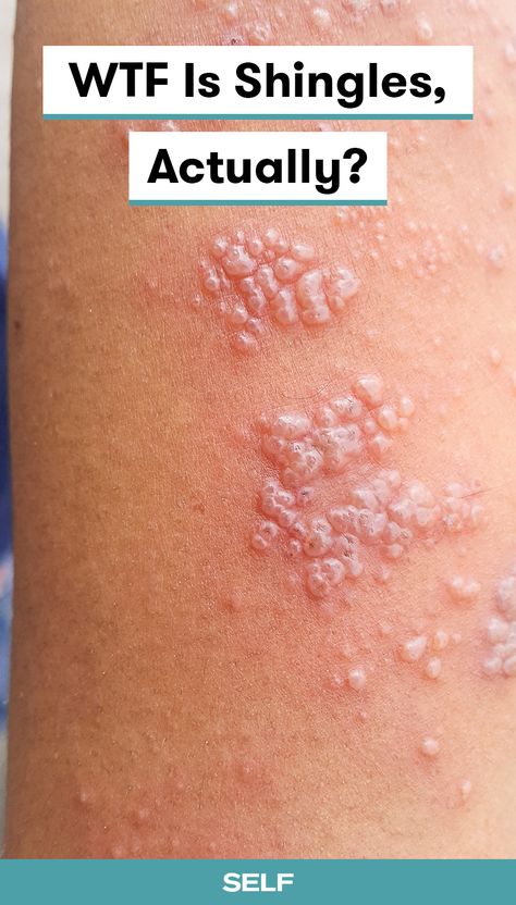 Shingles Symptoms Signs, Rash On Buttocks, Shingles On Face, Shingles Symptoms, Shingles Relief, Shingles Rash, Side Of Face, Cleaning Your Ears, Liver Diet