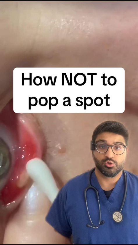 Eye Pimple, Cystic Acne On Chin, Painful Pimple, Pimple Solution, Pimple Causes, Big Pimple, Zit Popping, Clear Skin Routine, Get Rid Of Pimples