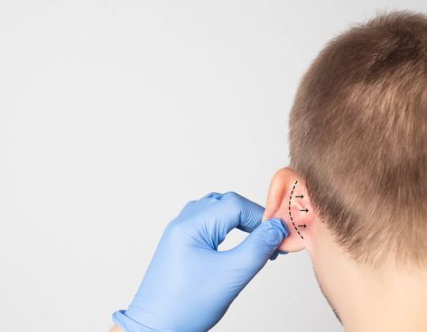 Otoplasty, more commonly referred to as ear surgery, is a common procedure for repositioning and reshaping prominent, unattractive ears. When the ears stick out, especially in childhood, the patient may be the target of teasing or ridicule and may have experiences that can lower self-esteem and lead to emotional trauma. Ears That Stick Out, Ear Surgery, General Anaesthesia, Reconstructive Surgery, Facial Plastic, Ear Pins, Cosmetic Procedures, Med Spa, Hilton Head