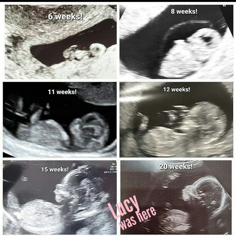 6 Weeks Pregnant Ultrasound, 20 Week Ultrasound, 12 Week Ultrasound, 6 Weeks Pregnant, 20 Weeks Pregnant, Baby Ultrasound, Ultrasound Pictures, 20 Weeks, School Things