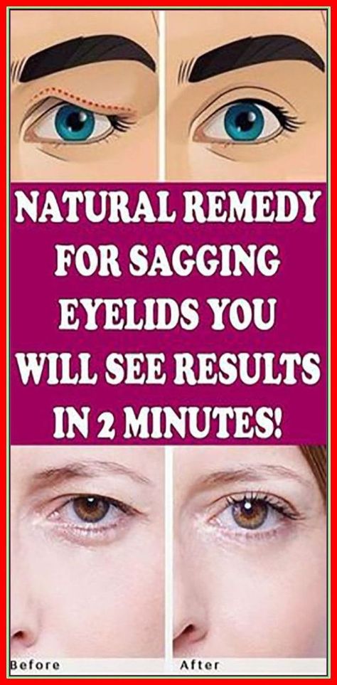 Natural Remedy for Sagging Eyelids – You Will See Results in 2 Minutes! Sagging Eyelids Natural Remedies, Remedies For Dry Mouth, Pinkeye Remedies, Sagging Eyelids, Home Remedies For Allergies, Home Remedies For Warts, Warts Remedy, Oily Skin Remedy, Natural Remedies For Migraines