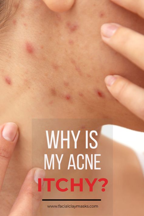 Nothing worse than a bug bite that itches, actually, there's nothing worse than itchy acne. So here's why your acne might be itchy.  Because if you don't know why your acne is itchy, then how can you work on preventing and treating it.  Plus I have some ideas for you on how to treat your acne.   #acne #itchy #itching #itch #pimple #skincare #onface #dry #remedies #causes Pimple Under The Skin, Cystic Acne Remedies, Acne Tips, Itchy Face, Blind Pimple, Bug Bite, Pimples Under The Skin, Pimples Overnight, Pimples On Face