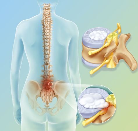 Illustration of a spinal disc herniation between L4/L5 (4th and 5th lumbar vertebrae) and L5/S1 (5th lumbar and 1st sacrum) Sciatica Symptoms, Lumbar Disc, Disk Herniation, Bulging Disc, Spine Surgery, Nerve Pain Relief, Sciatic Nerve Pain, Sciatica Pain, Neck And Back Pain