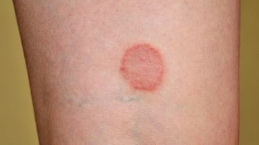 Skin Rashes Pictures, Skin Disease Pictures, Blood Blister, Fungal Infection Skin, Red Rash, Fungal Nail, Fungal Infection, Skin Disorders, Skin Diseases