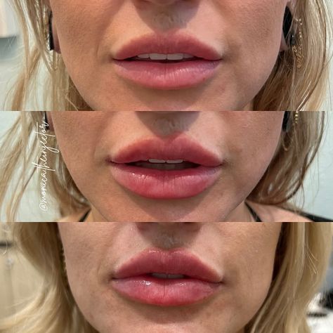 Lip Augmentation, Lip Filler, Kissable Lips, Lip Injections, Lip Fillers, Moving On, The Race, Beauty Inspiration, A Year