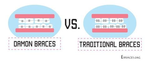 Damon braces vs Traditional braces : Which will be right for you? Damon Braces, Tiana Wedding, Ceramic Braces, Traditional Braces, Braces Colors, Orthodontics Braces, Content Inspiration, Oral Health, Braces