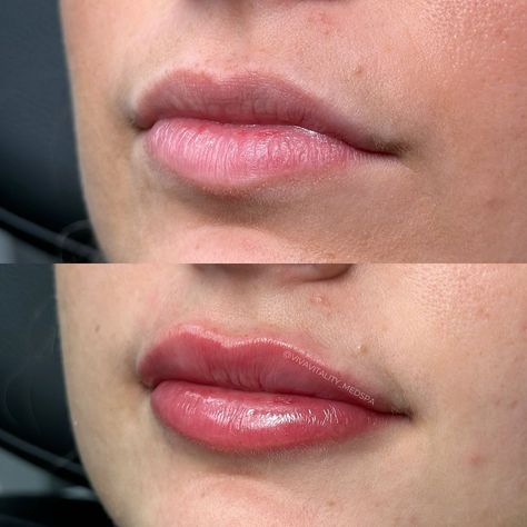 Before 👉 After One syringe of Restylane Kysse will do the trick! 💉👄 Book an appointment today with Brenda! It’s not too late to get the lips of your dreams. 💭 - - - - 👩🏼‍⚕️ Brenda Pribila (@aestheticinjector_brenda) __________________________________ Lip filler, before and after, Cosmetic injector, aesthetics, lakeland medspa, medspa before and after, natural lips #lipfiller #lipfillerbeforeandafter #beforeandafter #cosmeticinjector #aesthetics #naturallips #lakelandfl #lakelandmedspa #m... Lip Fillers Before And After, Jolie Lip Filler, Lip Filler Before And After, Lip Filler Inspo 0.5ml, .5ml Vs 1ml Lip Filler, 0.55ml Lip Filler, Cosmetic Injector, 1.5 Ml Lip Filler, Lip Filler