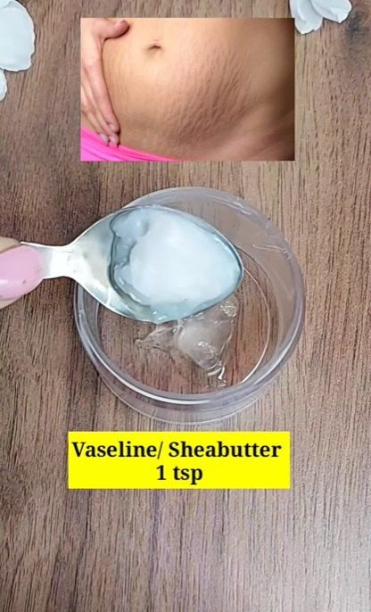 Get Rid of Stretch Marks With This DIY Recipe | Upstyle Strech Marks Removal At Home, How To Get Rid Of Strech Marks On But, How To Get Rid Of Strech Marks On Thighs, Strechmark Remover Skin Care, Strech Marks, Stretch Mark Remedies, Marks Cream, Scar Cream, Skincare Secrets