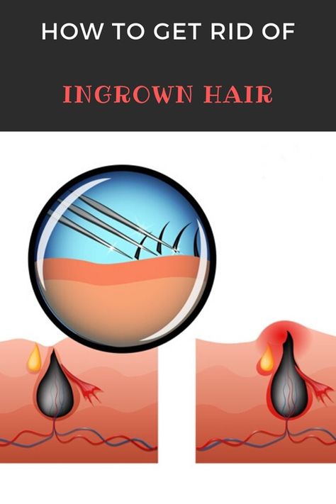 They itch, hurt and look unattractive: ingrown hair. But how can you prevent them and what helps once they are there? And can they really lead to blood poisoning? How To Get Rid Of Ingrown Hairs On Vag, Ingrown Pimple, Ingrowing Hair, Treat Ingrown Hair, Ingrown Hair Remedies, Bump Hairstyles, Chin Hair, Nail Infection, Holistic Diet