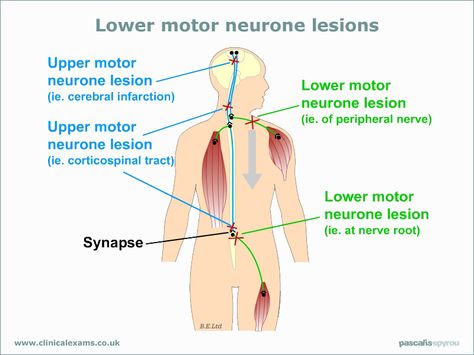 Lower Motor Neuron Vs. Upper Motor Neuron....confusing to me since grad school....but a visual helps:) Upper Motor Neuron, Upper Motor Neuron Vs Lower Motor Neuron, Neuron Diagram, Knee Replacement Exercises, Peripheral Nervous System, Motor Neuron, Peripheral Nerve, Cranial Nerves, Medical Training