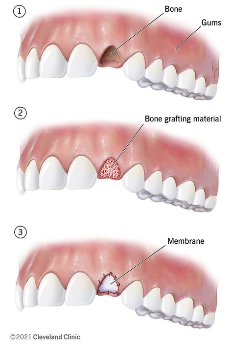 Dental Bone Graft: Process, Healing & What It Is Maxillary Sinus, Types Of Bones, Bone Grafting, Dental Implant Surgery, Gum Recession, Oral Surgeon, Restorative Dentistry, Tooth Extraction, Mad Max Fury