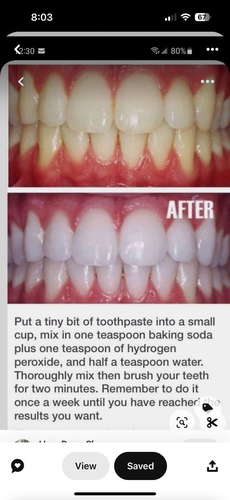 Natural Teeth Whitening Diy, Kesehatan Gigi, Diy Coconut Oil, Teeth Whitening Remedies, Teeth Whitening Diy, Charcoal Teeth Whitening, Baking Soda Shampoo, Natural Teeth Whitening, Natural Teeth