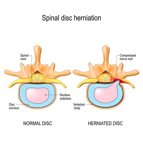 Cervical Disc, Disc Herniation, Lumbar Disc, Intervertebral Disc, Spinal Column, Disk Herniation, Bulging Disc, Spinal Nerve, Rare Occasions