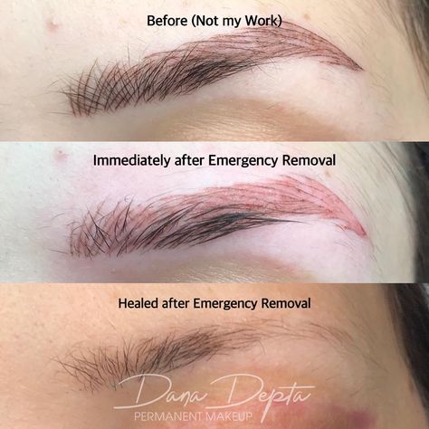 Remove Microbladed Brows, Bad Microblading, Permanent Makeup Removal, Eyebrow Tattoo Removal, Micro Pigmentation, See True, Faux Freckles, Red Pigment, Semi Permanent Makeup