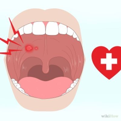 Blisters In Mouth Remedies, Roof Of Mouth Sore Remedy, How To Get Rid Of Sores In Your Mouth, Mouth Sore Remedy How To Get Rid, Blister On Tongue, Sore In Mouth Remedies, Roof Of Mouth Sore, Blister In Mouth, Heal Blisters