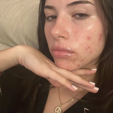 fernanda Acne Normalization, Acne Aesthetic Girl, Acne Girls Pretty, Pretty With Acne, Acne Embrace, Normalizing Insecurities, Acne Is Beautiful, Normalize Acne, Pretty People With Acne