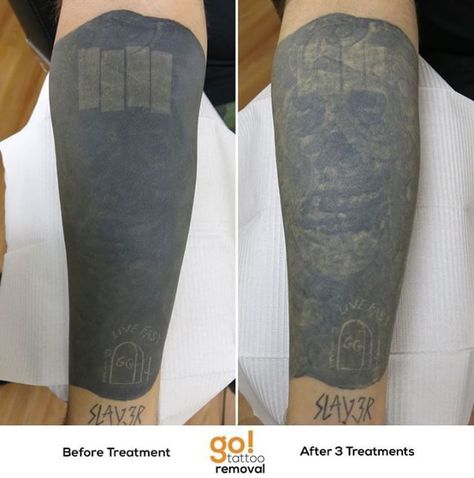 Forearm Tattoo Removal Really Bad Tattoos, Tattoo Removal Cost, Web Tattoo, Laser Removal, Inner Forearm, Original Tattoos, Bad Tattoos, Laser Tattoo, Laser Tattoo Removal