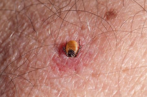 Tick burrowing in skin. Tick burrowing in human skin , #AFFILIATE, #burrowing, #Tick, #human, #skin #ad Kill Ticks In Yard, Get Rid Of Ticks, Makeup Life Hacks, Tick Bite, Life Hacks Every Girl Should Know, Tick Repellent, Natural Bug Repellent, Diy Xmas Gifts, Lawn And Landscape