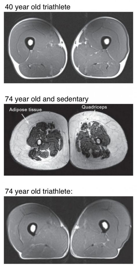 This is an MRI cross section of a 74yo sedentary test subject. Check out the site to compare it to the cross sections from an athlete of the same age as well as from a 40yo athlete. Shocking. Human Legs, Mri Scan, Adipose Tissue, Save Your Life, Leg Muscles, What Really Happened, Sports Medicine, Sport Motivation, I Work Out