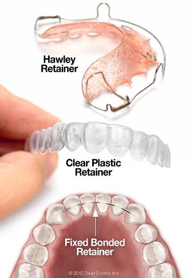 Paris Hart | Invisalign vs Braces Retainers After Braces, Different Types Of Teeth, Hawley Retainer, Types Of Teeth, Braces Clear, Braces Retainer, After Braces, Dental Retainer, Orthodontic Appliances