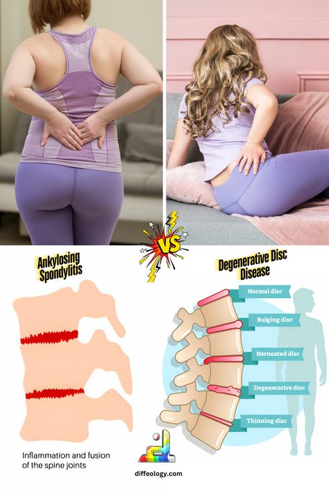 Ankylosing Spondylitis Vs. Degenerative Disc Disease Bulging Disc, Business And Economics, Sales And Marketing, Disease, Key, Health, How To Wear