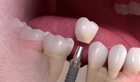 oral hygienr advice and care about dental implants Free Dental Implants, Affordable Dental Implants, Dental Implant Procedure, Best Dental Implants, Dental Implant Surgery, Dental Implants Cost, Tooth Replacement, Implant Dentistry, Missing Teeth