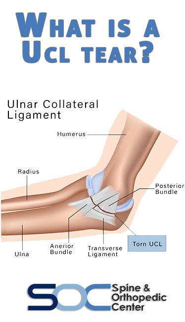 What is a UCL Tear? A UCL tear typically occurs through repeated stress from overhead movement. Usually, this occurs over time and if noticed early on, the amount of damage is likely to decrease. An ulnar collateral ligament injury is normal in sports that require overhead arm use, such as baseball and javelin. Pain Medicine, Chronic Back Pain, Ligament Injury, Yoga For Back Pain, Human Body Anatomy, Increase Muscle Mass, Yoga Positions, Neck And Back Pain, Body Tissues