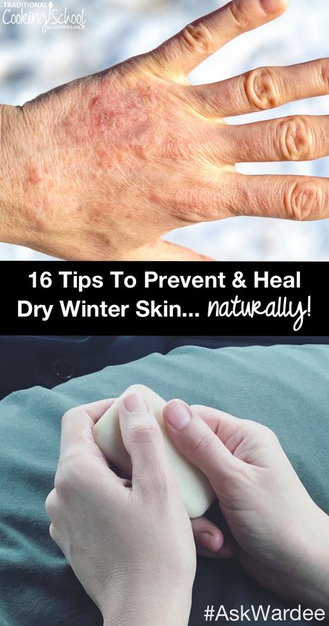 Dry Skin Remedies For Body Winter, Severe Dry Skin Remedies, Best Lotion For Dry Skin Winter, Extreme Dry Skin Remedy, Dry Winter Skin Remedies, Dry Hands Remedy, Homemade Creams, Dry Hand Skin, Medicine Recipes