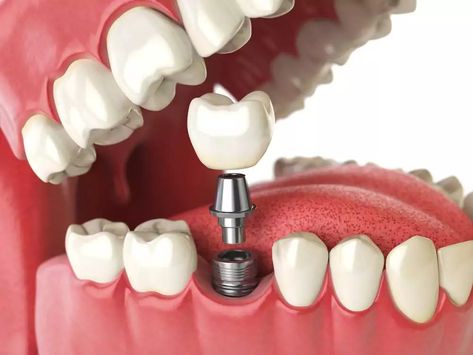 Free Dental Implants, Dental Studio, Affordable Dental Implants, Dental Implant Procedure, Implant Dentist, Best Dental Implants, Dental Implant Surgery, Gorgeous Smile, Kedokteran Gigi