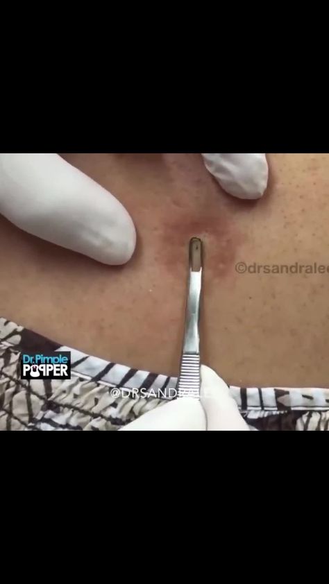 Sandra Lee, MD, FAAD, FAACS | All the little pops you might have missed 👀 #drpimplepopper #fbf | Instagram Sandra Lee, How To Get Rid Of Pimples, On Instagram, Quick Saves, Instagram