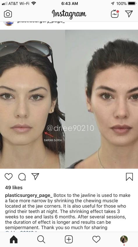 Fox Eye Thread Lift Before And After, Jaw And Cheek Filler, Fox Eye Lift Surgery, .5ml Lip Filler, Mommy Makeover Surgery, 1.5 Ml Lip Filler, Rhinoplasty Surgery, Beauty Procedures, Botox Face