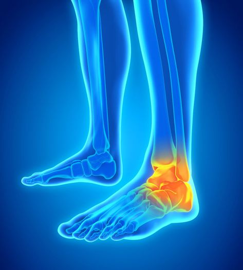 Foot-Ankle Pain | Foot-Ankle Injury | Foot Surgeon | Foot Surgery Achilles Tendon Ruptures, Dadar Mumbai, Ankle Ligaments, Ankle Sprain, Chronic Lower Back Pain, Ligament Injury, Lower Back Pain Exercises, Back Pain Remedies, Ankle Pain