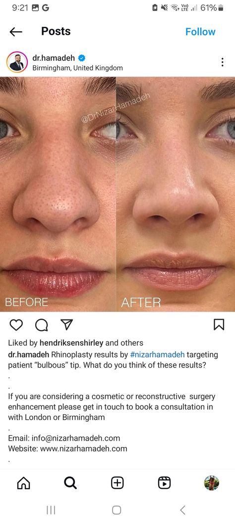 Small Nose Job, Bulbous Nose Job, Nose Job Natural, Fox Eye Lift Surgery, Thick Skin Rhinoplasty, Rynoplasty Surgery, Alarplasty Before After, Subtle Nose Job, Asian Rhinoplasty Before After