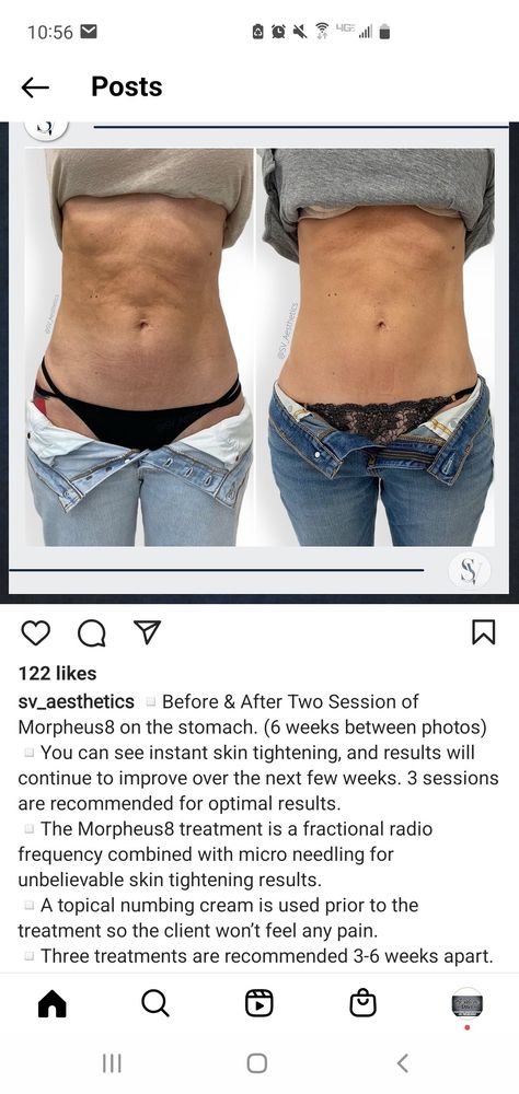 Dermarolling Stomach, Microneedling Before And After, Radio Frequency Skin Tightening, Numbing Cream, Derma Roller, Ab Workout, Radio Frequency, Skin Tightening, Smooth Skin