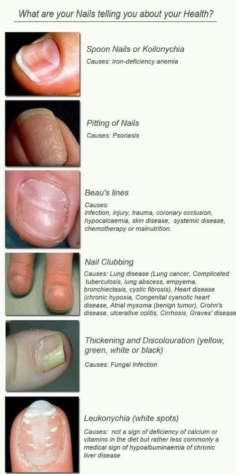 Nail Health Signs, Med Aesthetic, Nail Anatomy, Forensic Medicine, Dermatology Nurse, Nail Disorders, Nail Problems, Health Chart, Fungal Nail