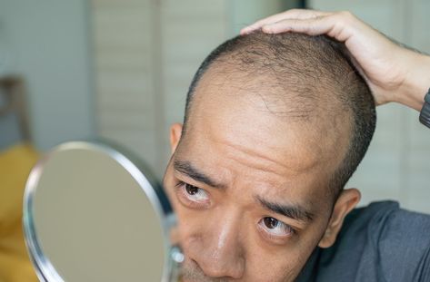 Which Vitamin Deficiency Causes Hair Loss? Zinc Deficiency, Androgenetic Alopecia, Hair Growth Cycle, Vitamin Deficiency, Hair Growth Supplement, Hair Shedding, Scalp Conditions, Thinning Hair, Hair Regrowth