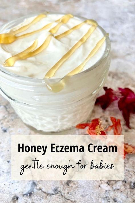 Homemade Excema Cream, Homemade Excema Remedy, Body Butter For Excema, How To Heal Excema, Lotion For Excema, Diy Excema Cream Recipes, Excema Remedies For Face, Baby Excema Remedies Diy, Exema Treatments Natural