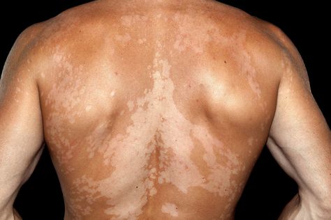 Causes of Skin Discoloration | WebMD Closed Comedones, Skin Blackheads, Hydrocortisone Cream, Scaly Skin, Types Of Acne, Lighter Skin, Skin Disorders, Skin Diseases, Skin Discoloration